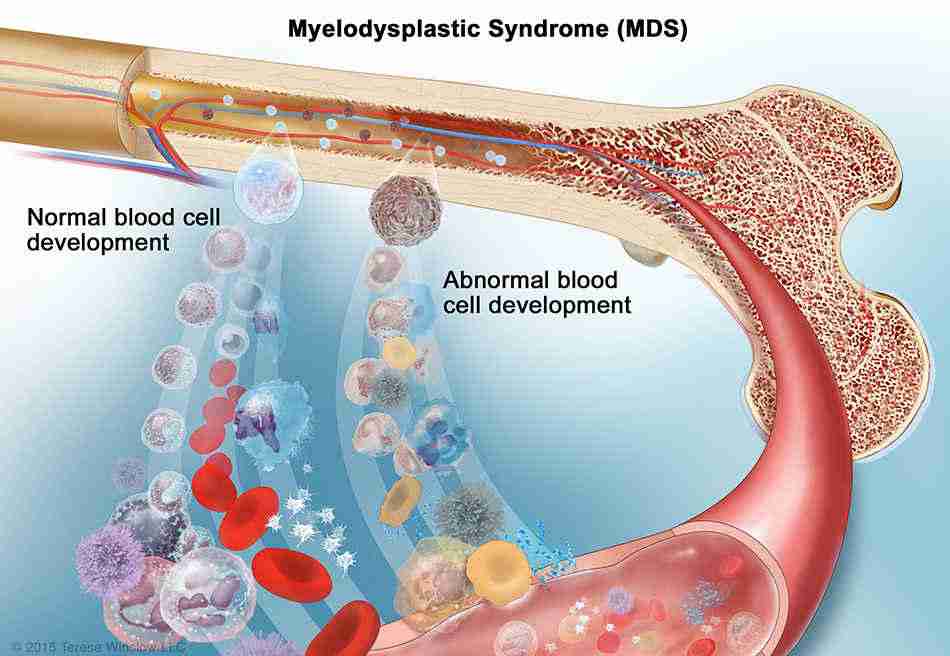 Myelodysplastic-Syndromes-MDS-Treatment
